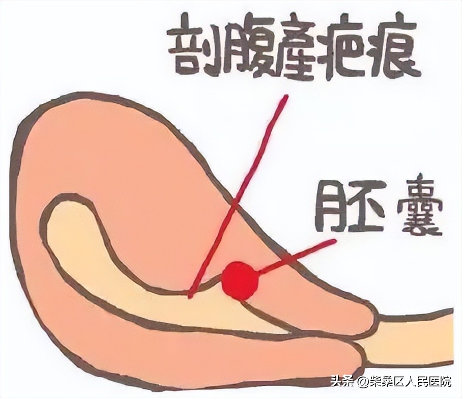 剖宫产疤痕妊娠不要慌，柴桑区人民医院妇科团队为您排忧解难