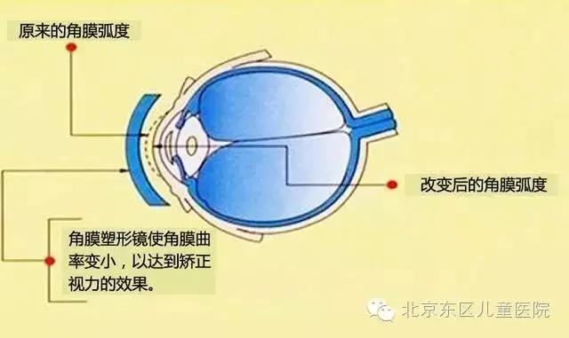 近视防控镜与角膜塑形镜哪个好,角膜塑形镜ok镜