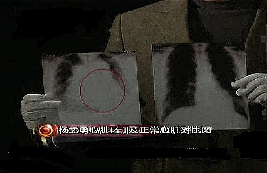 心脏移植27岁小伙换上57岁的心脏,60岁移植26岁小伙的心脏