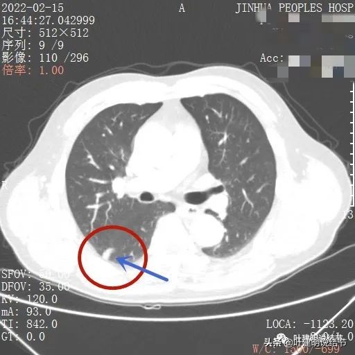 肺腺癌高危亚型什么意思,肺腺癌高危亚型