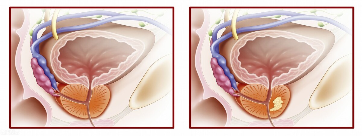 晚上起夜多次各种检查都正常为啥,晚上起夜2-3次算正常吗