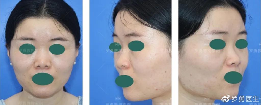 鼻综合鼻头挛缩山根太高怎么修复,鼻综合后山根太低