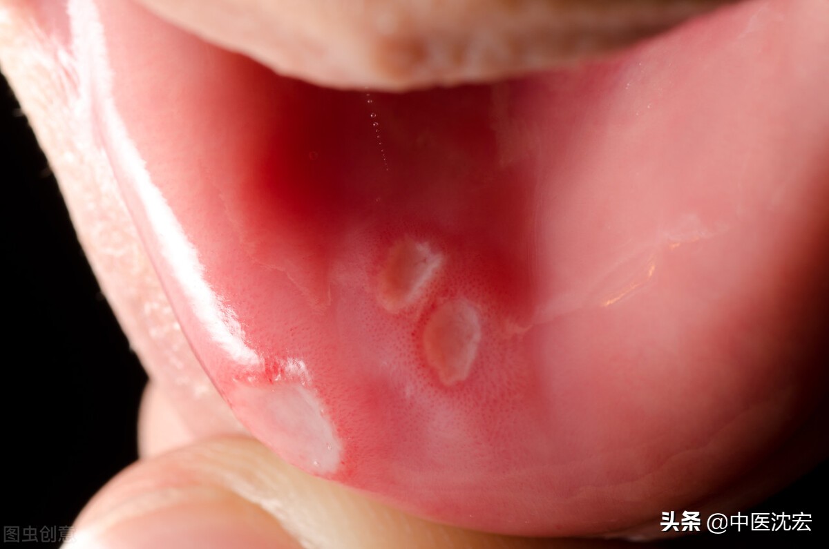 口腔溃疡最见效的泻火方法,口腔溃疡去火用药