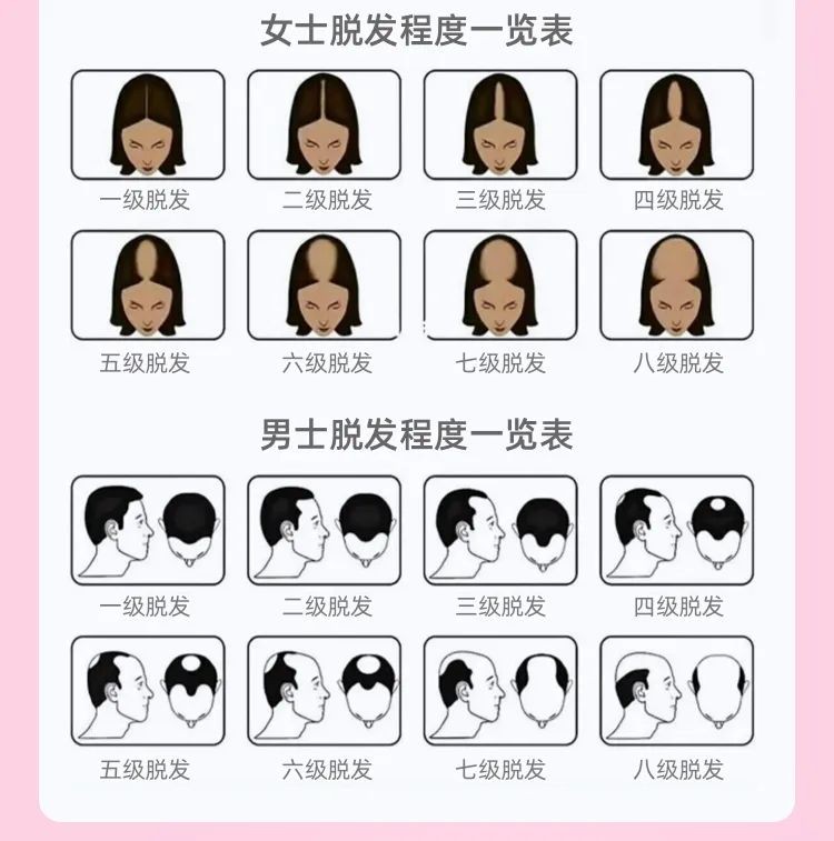 脱发严重要不要植发？有没有更好的治疗方法？