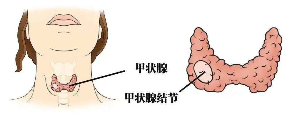 甲状腺癌是“懒癌”?别低估其破坏力