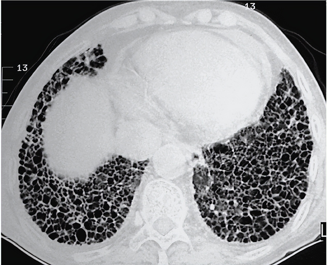 妻子用百草枯给丈夫洗*裤内**，导致丈夫*体下**溃烂，两颗蛋蛋瞬间报废
