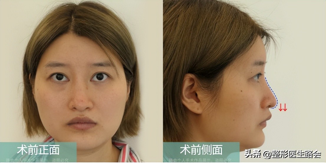 隆鼻手术全过程女生,隆鼻手术到底是怎么进行的