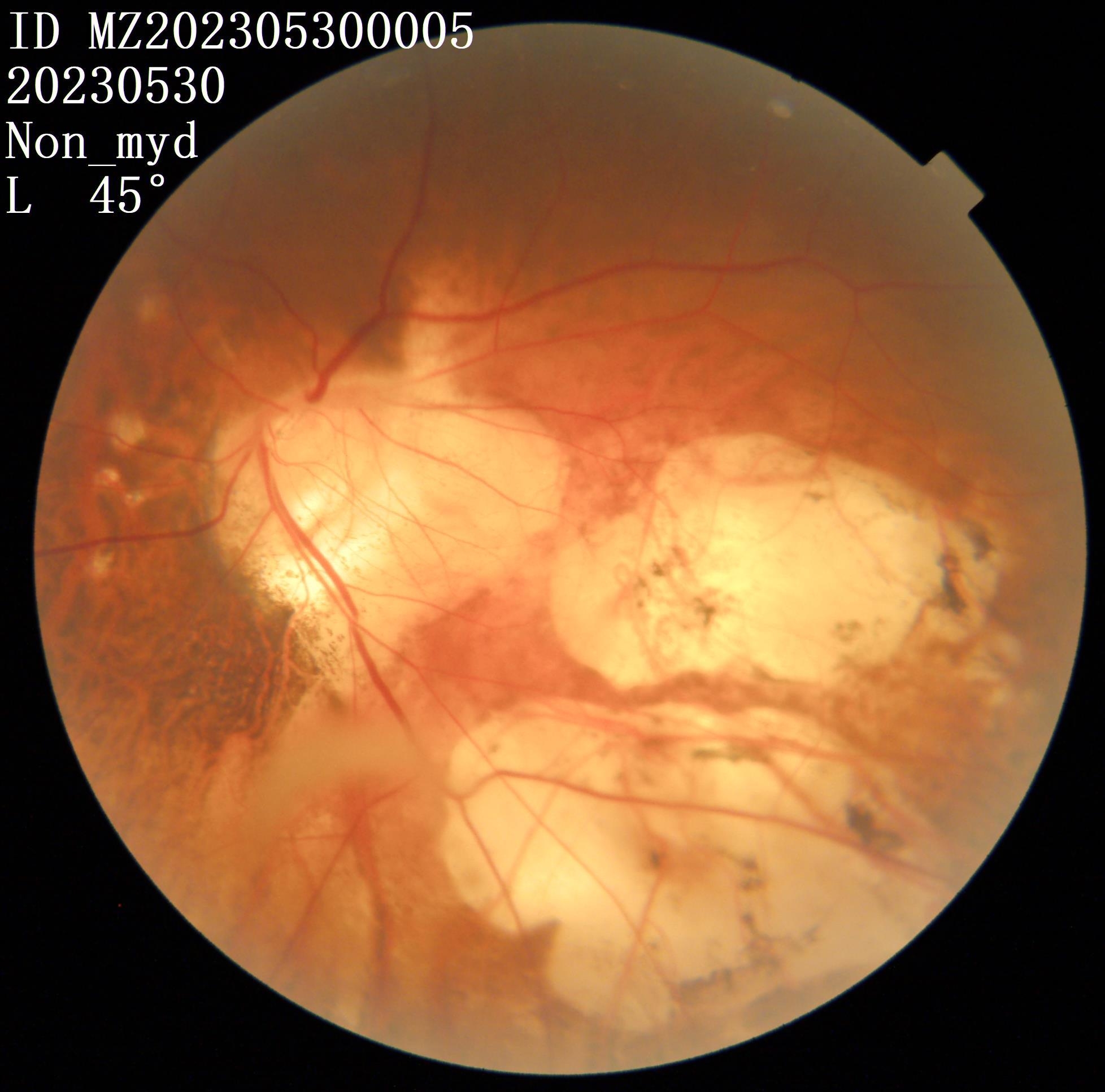 这样“破烂”的超高度近视眼底，还有手术价值吗？