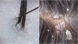 出门头皮屑多怎么去除最简单方法,头皮屑太多怎么去除最简单方法