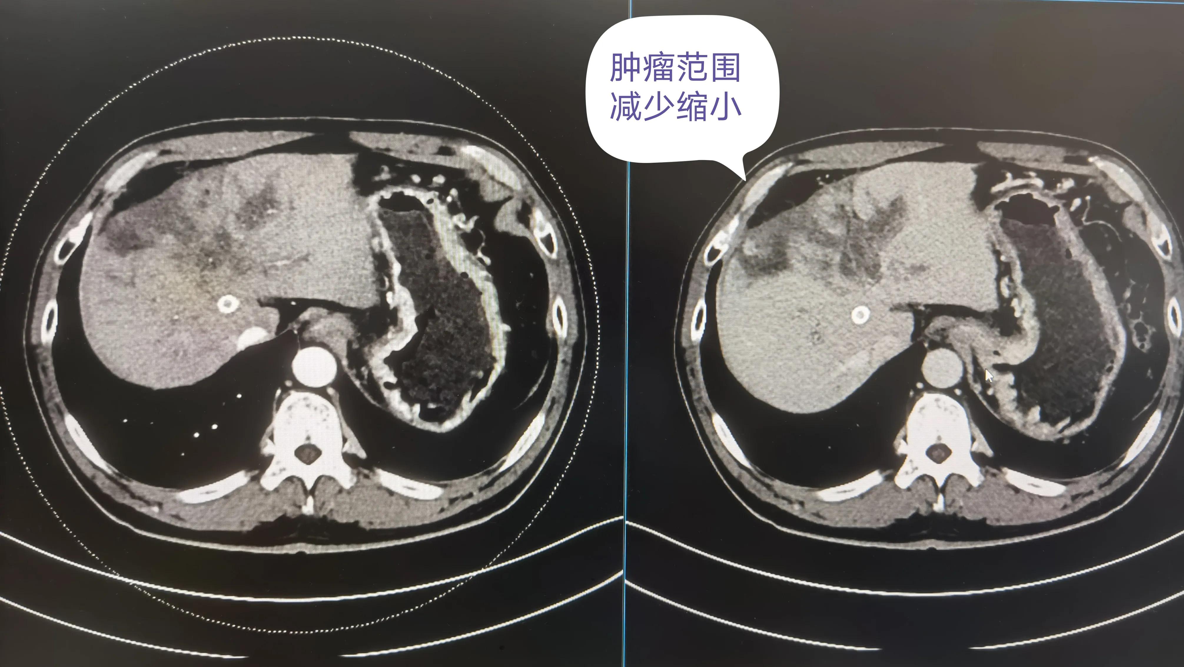 肝癌晚期伴胃溃疡出血,肝癌晚期合并脑卒中