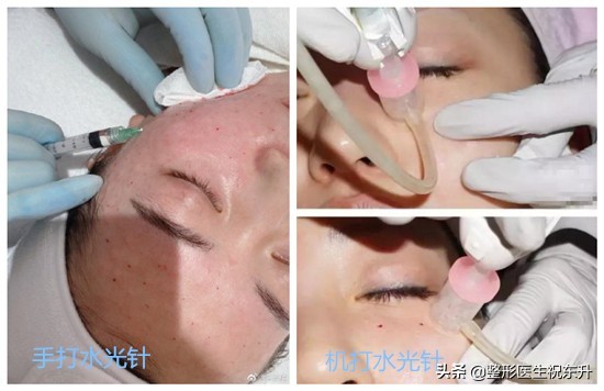 关于水光针的知识解析,水光针的十问十答