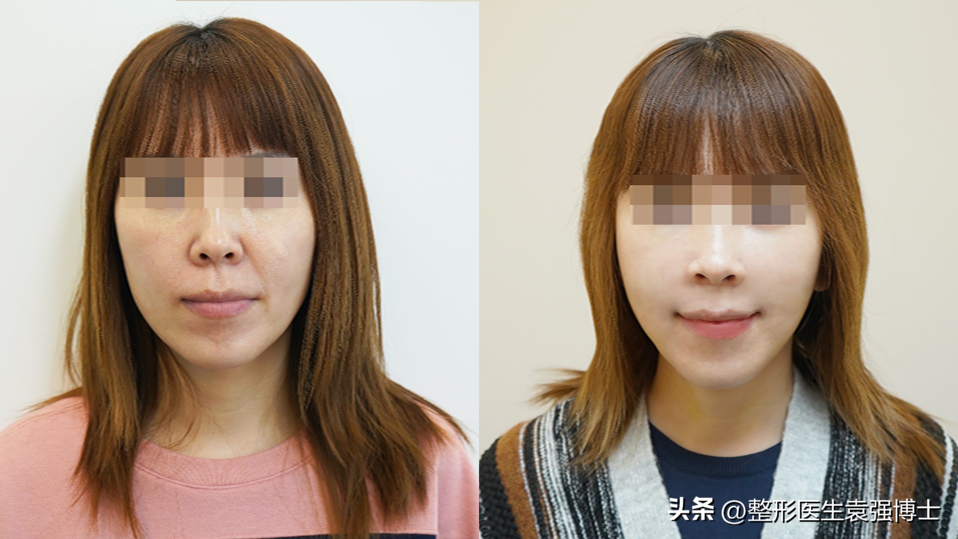 法令纹难去除，多是没弄清成因，医生教你几招实用的方法