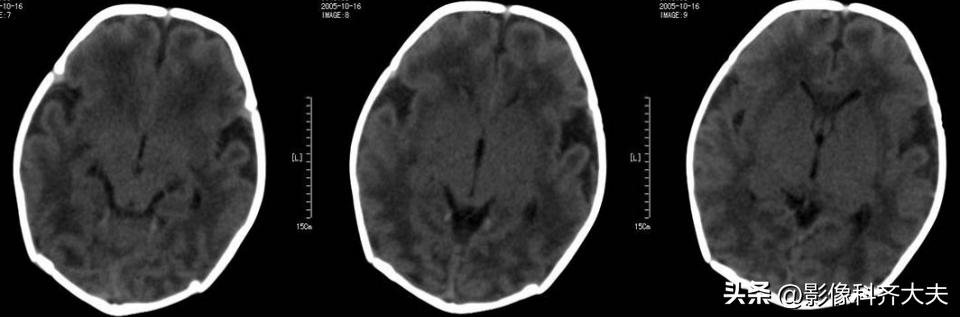 新生儿缺氧缺血性脑病的mr诊断,新生儿缺血缺氧脑病的ct表现
