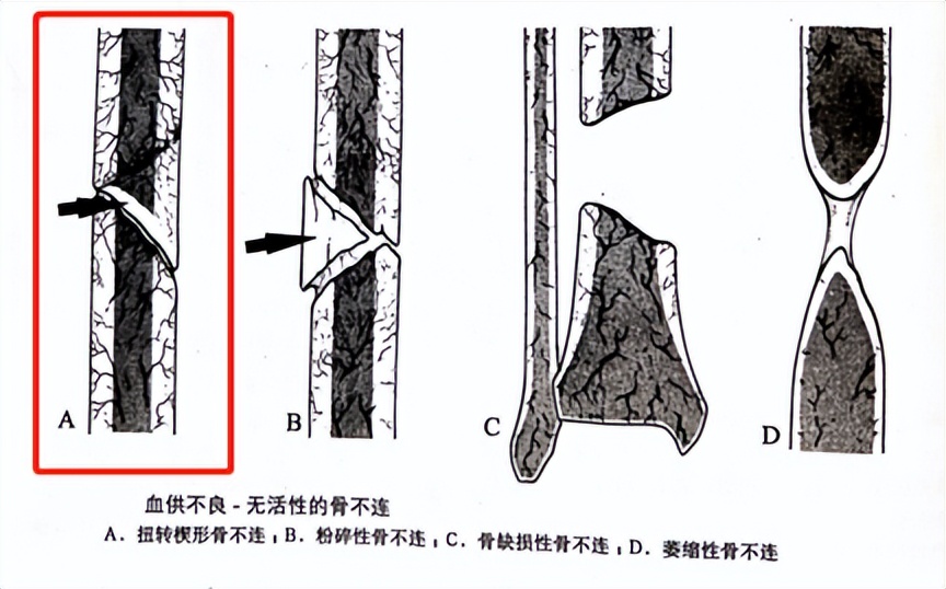 治疗骨折新技术,微创手术治疗骨折的方法