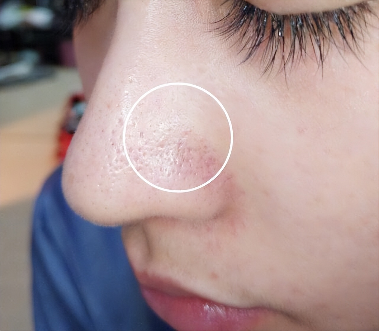 鼻子螨虫怎么去除简单方法是什么,鼻子一挤就出好多白色的螨虫