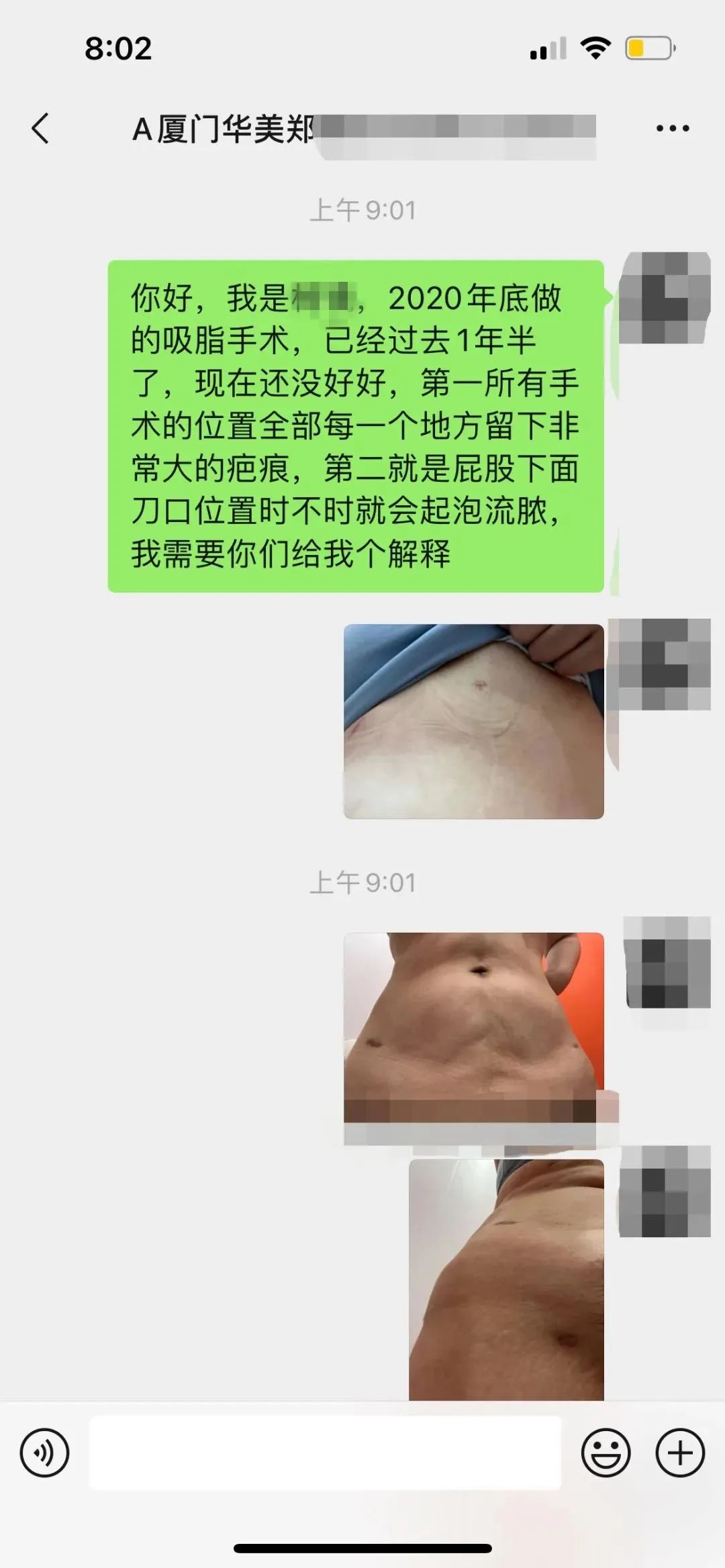 女子去抽脂手术后脸上溃烂,厦门华美整形医院抽脂