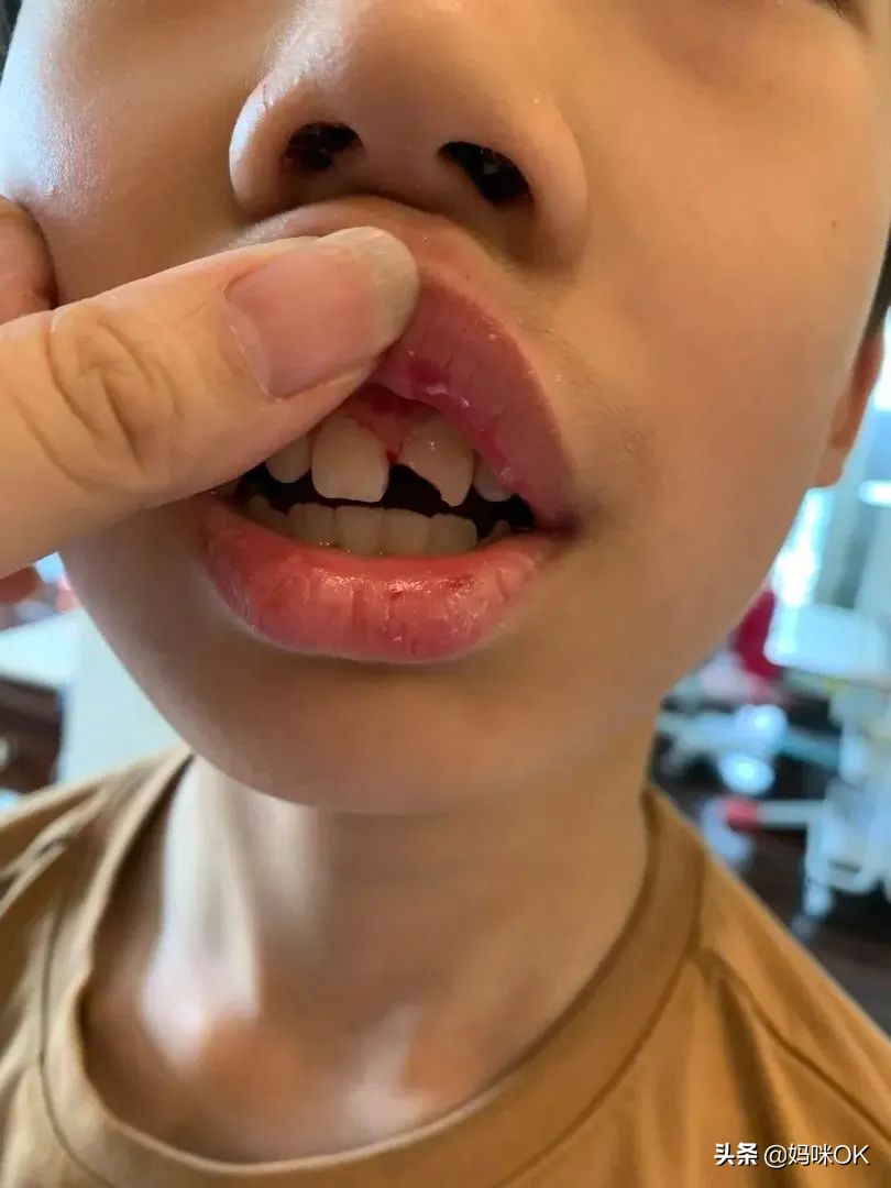 18岁前不能再用门牙吃东西！儿子的这一跤摔得有点惨痛