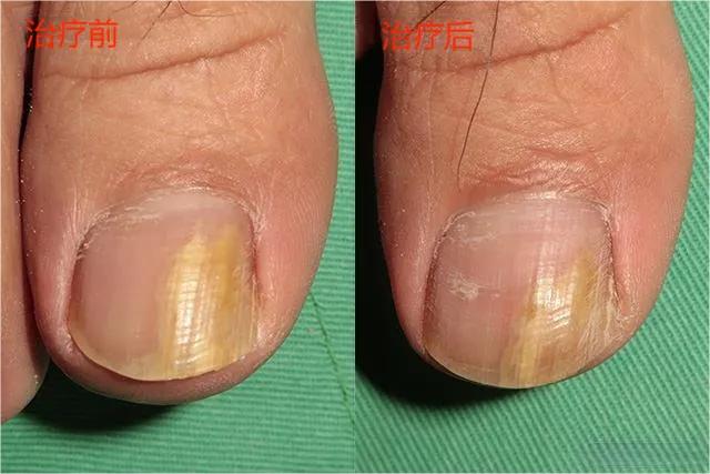 甲癣不严重怎么治疗,甲易生治疗灰指甲吗