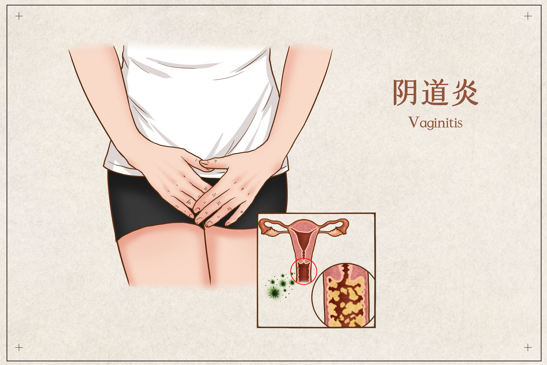 如何预防老年性阴道炎的症状,如何预防老年性阴道炎症状