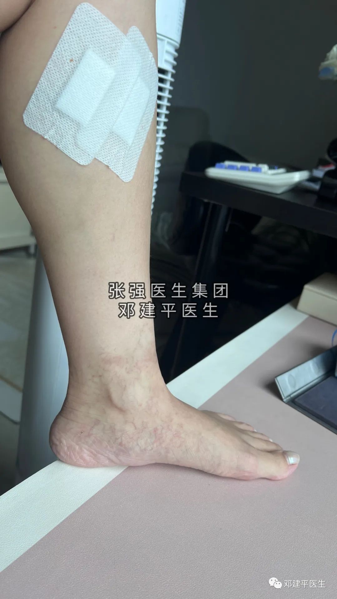 下肢静脉曲张非手术治疗护理,下肢静脉曲张2级吃药可以消除吗