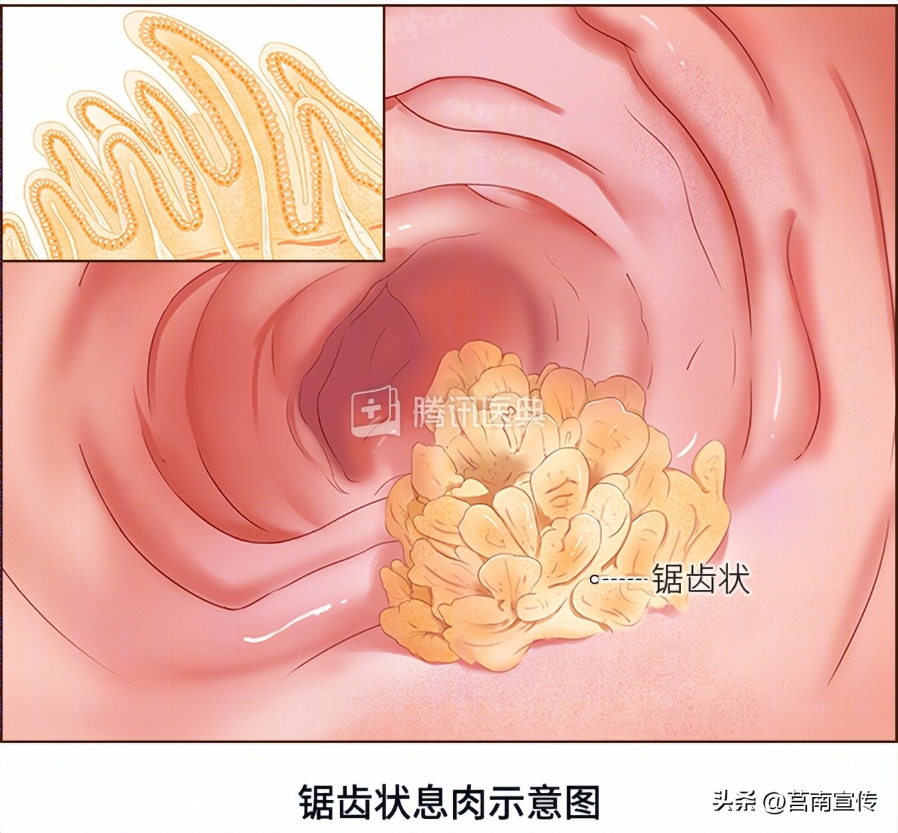 发现息肉，离癌有多远？