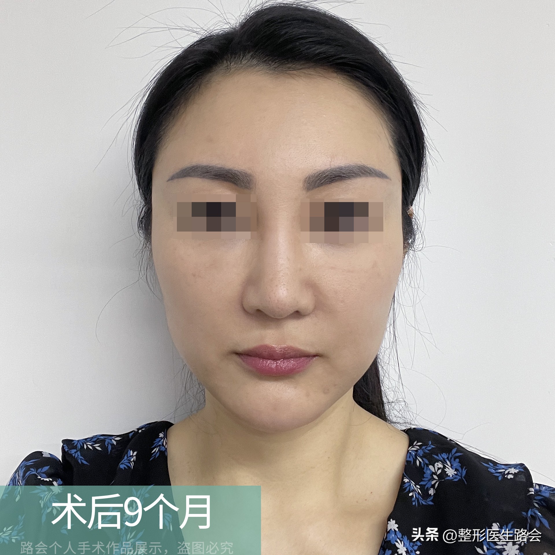 做鼻基底填充消除法令纹有风险吗,鼻基底填充能消除法令纹吗