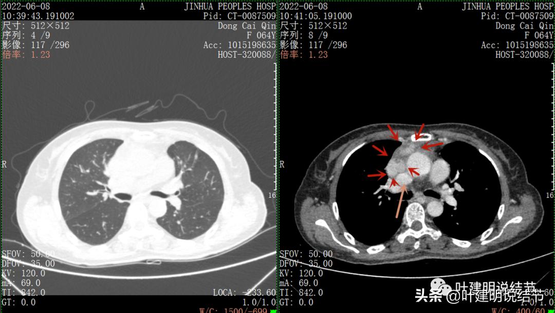 这位老乡，乏力来查，查出这么大个的纵隔肿瘤！会是什么呢？