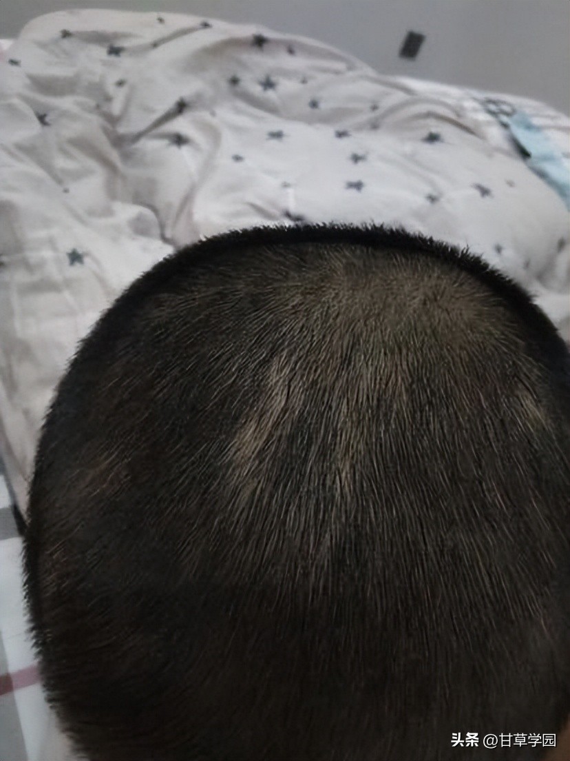 复方甘草治疗斑秃,甘草煮水治疗斑秃效果好吗