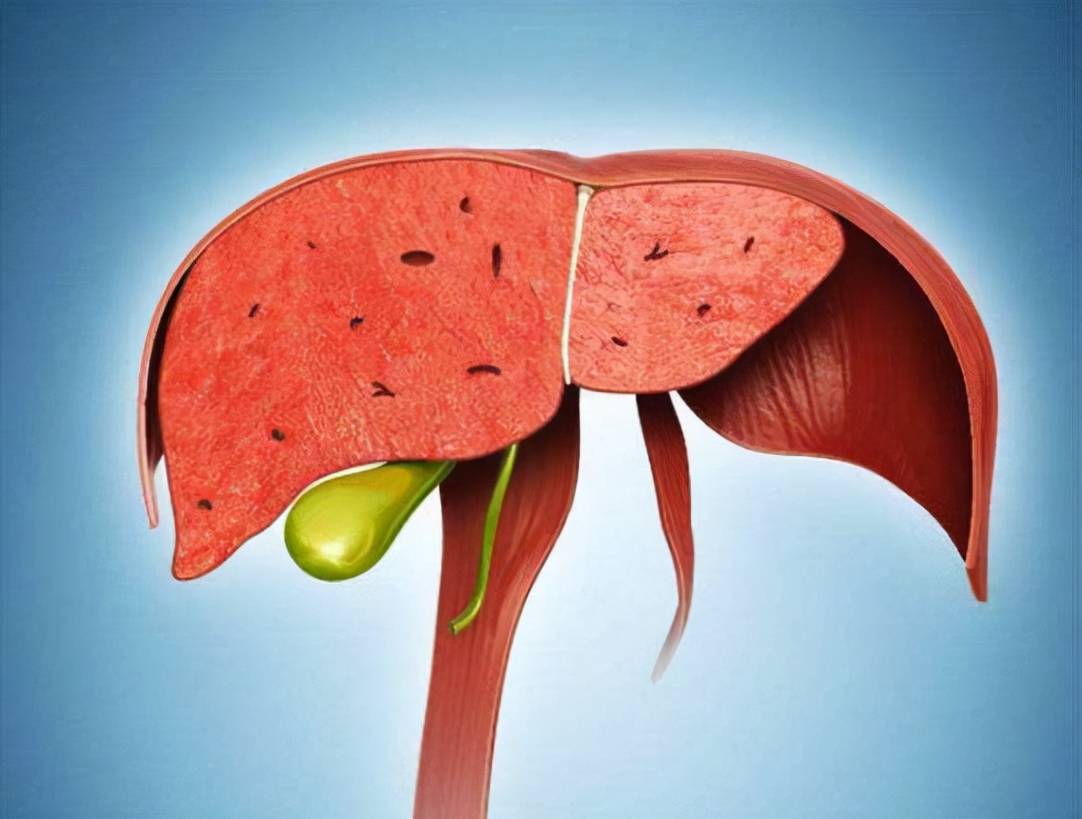 大蒜是肝病的“发物”？医生提醒：若想养肝，这4种食物尽量少吃