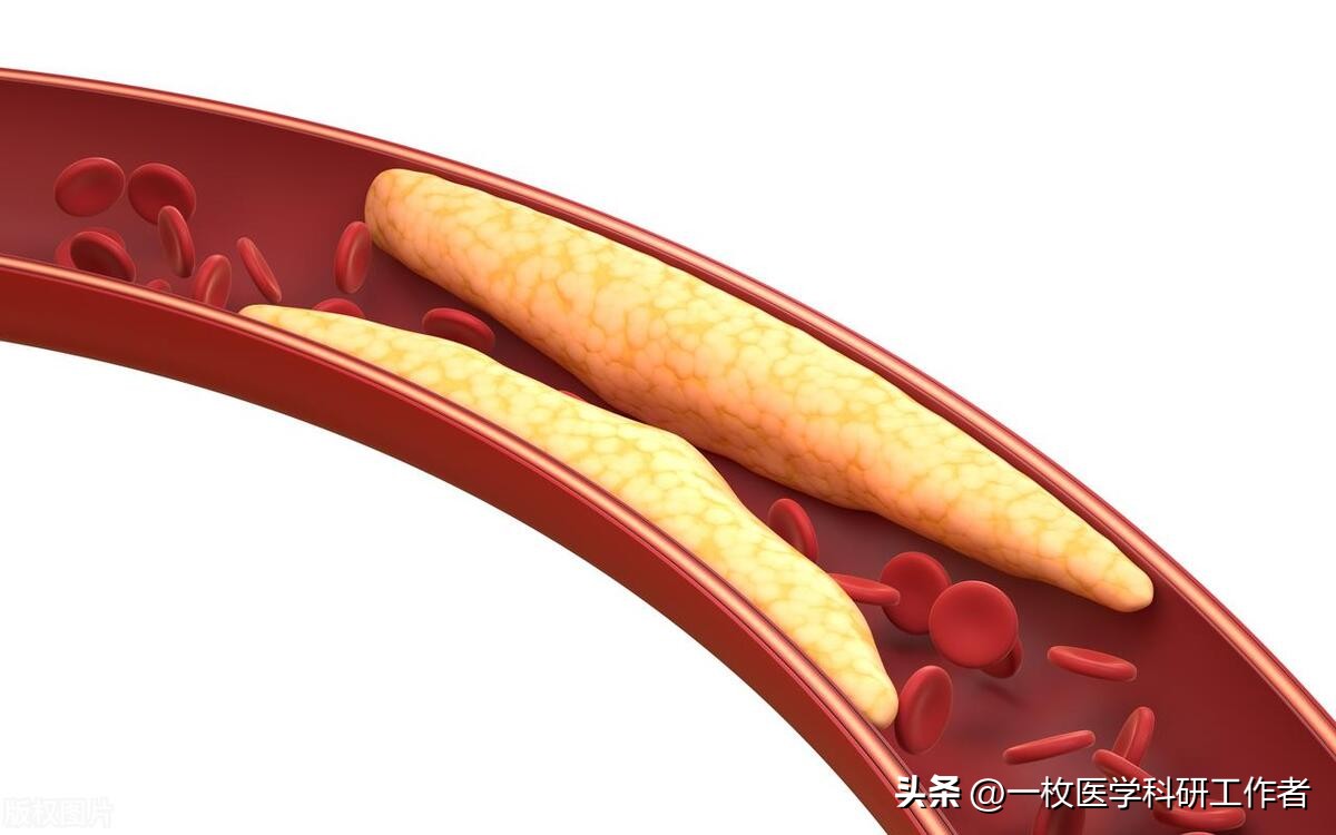高血压高血脂动脉硬化是基础病吗,高血脂会引起主动脉夹层吗