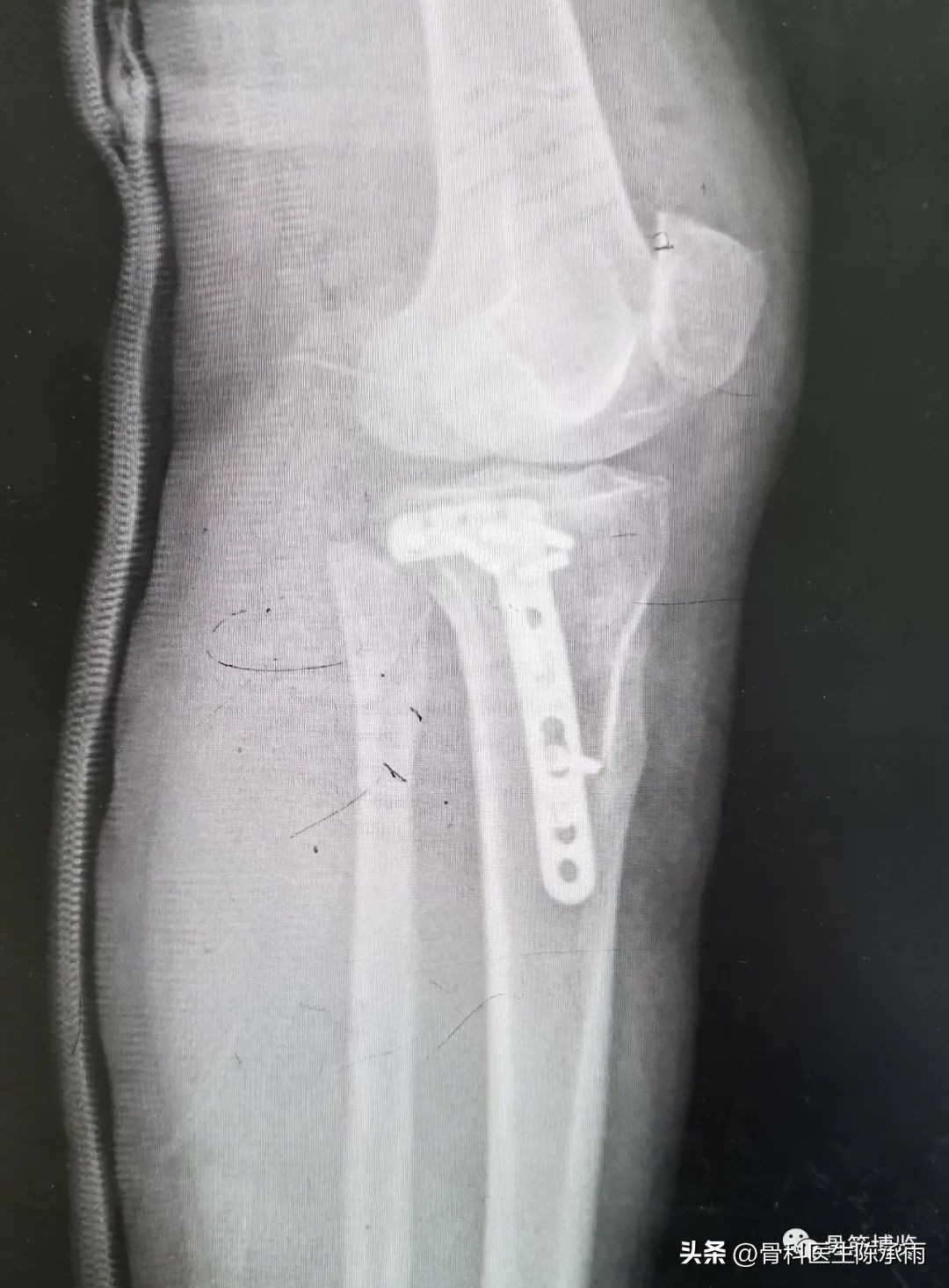 膝关节胫骨平台骨折,最近胫骨平台骨折视频