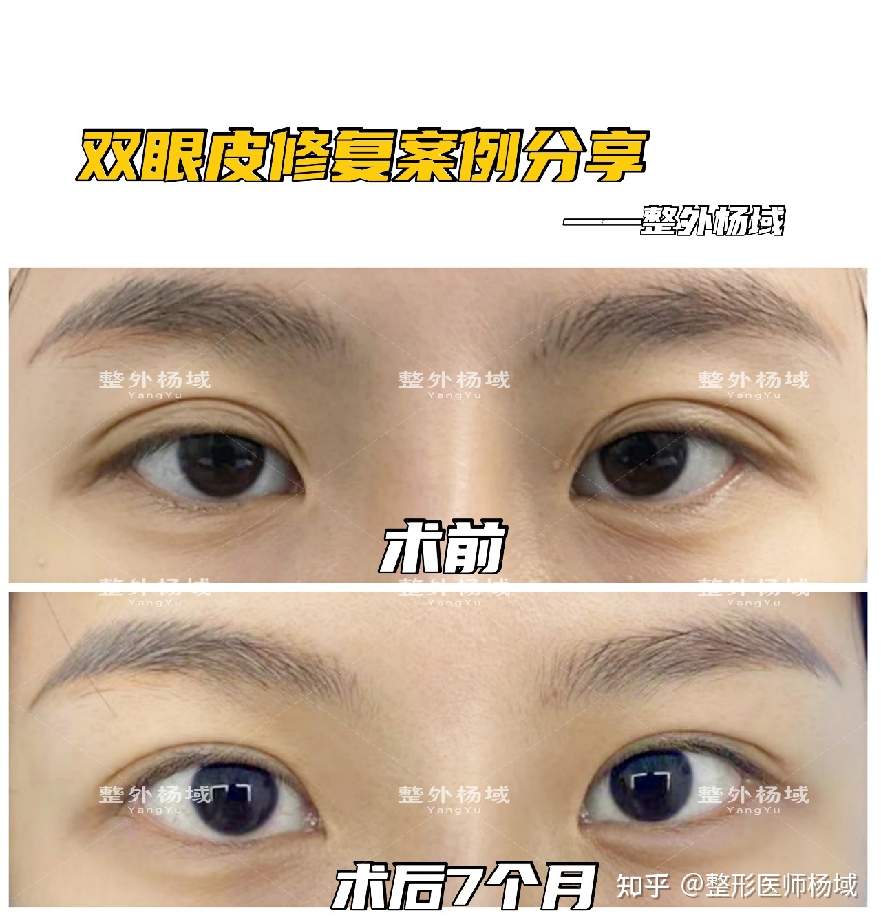 冯传波割双眼皮失败过吗,割双眼皮有褶子是失败了吗