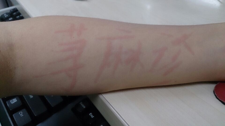 荨麻疹老是反复发作痒怎么治,荨麻疹有灼热刺痒怎么快速解决