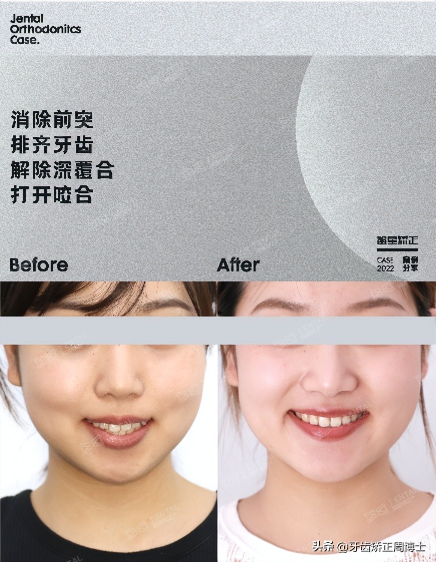 低角面型下巴前倾正畸案例,露龈笑嘴凸下巴后缩