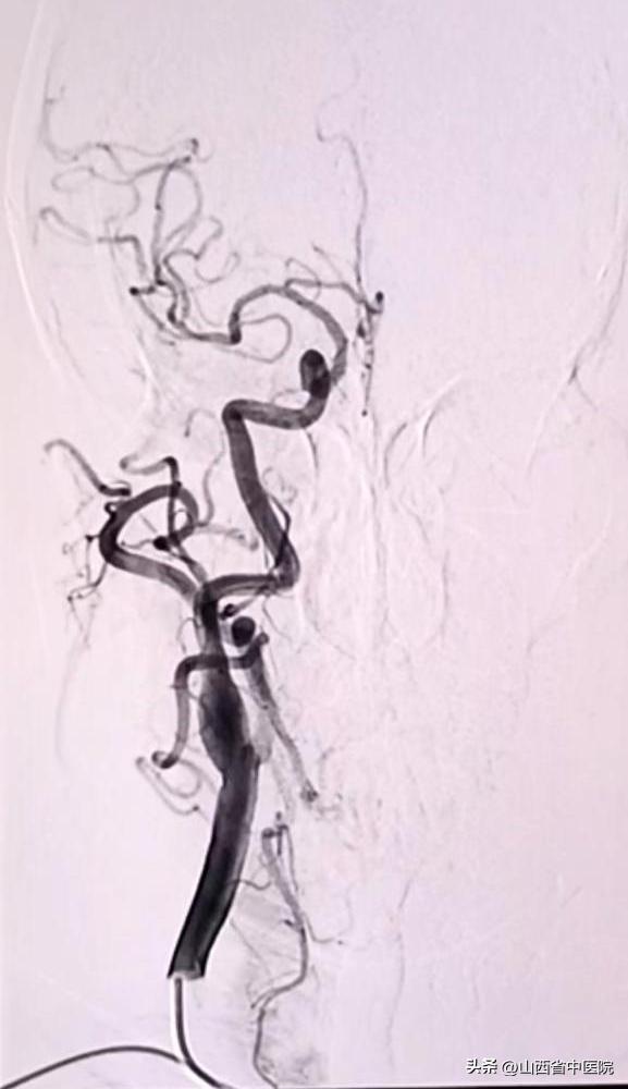 脑梗死偏瘫怎么治愈,急性脑梗死康复锻炼视频