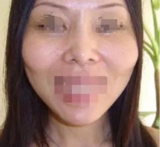 颧骨突出外扩图片,左侧颧骨外扩凸出