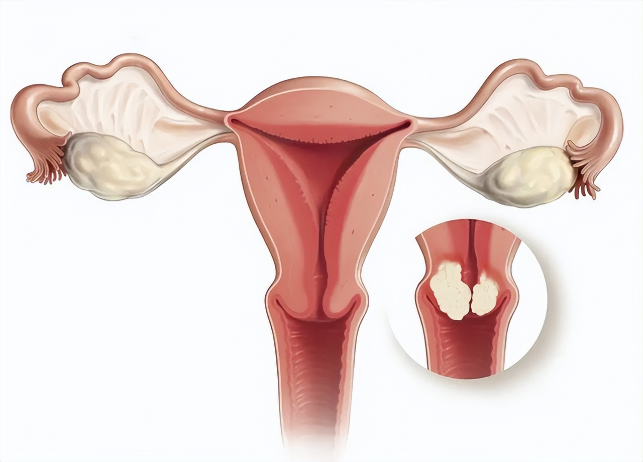 恶露排出像肉一样的血块,来事有血块像肉一样是怎么回事