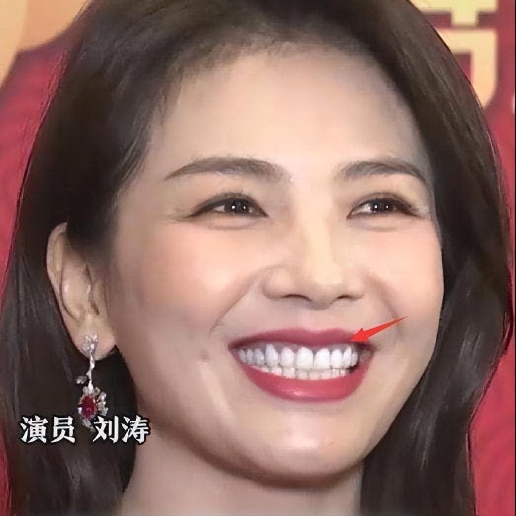 明星有哪些都是烤瓷牙,明星烤瓷牙为什么很丑