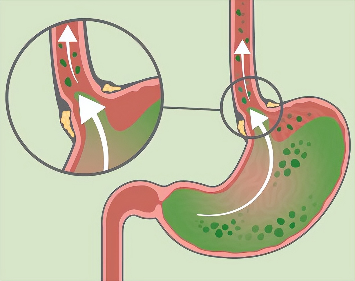 胆囊息肉切除后遗症怎样才能恢复,手术切除胆后有什么影响