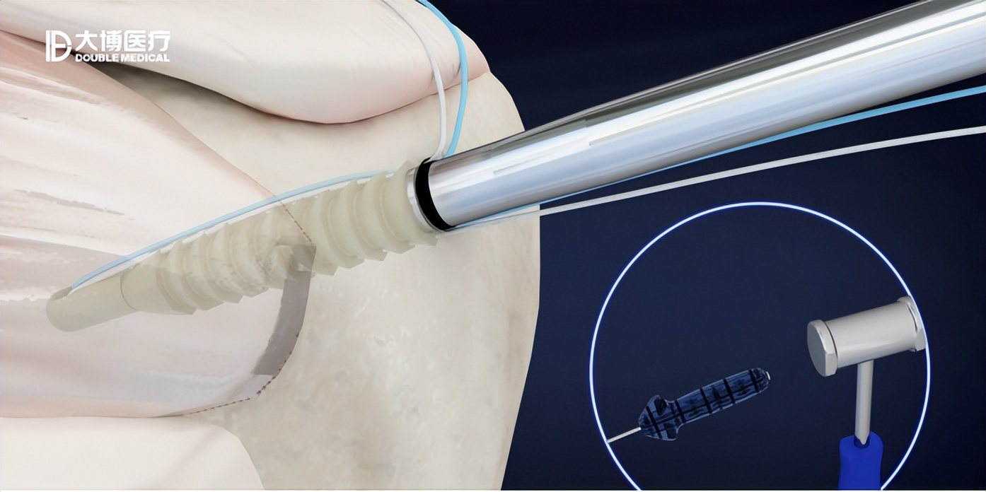 大博医疗发展,大博医疗转型