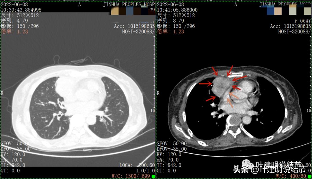 这位老乡，乏力来查，查出这么大个的纵隔肿瘤！会是什么呢？
