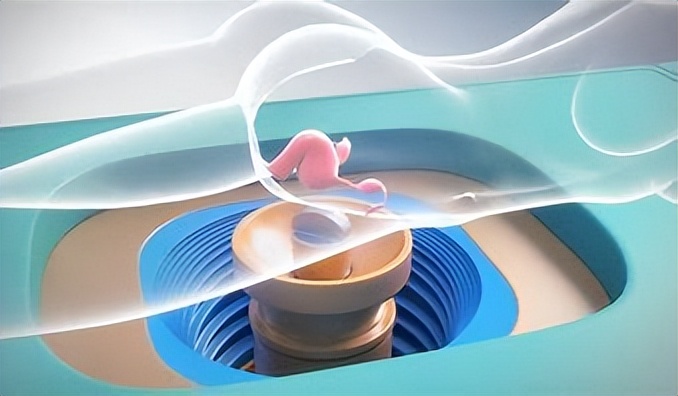 海扶刀很好吗,海扶刀为啥叫海扶刀