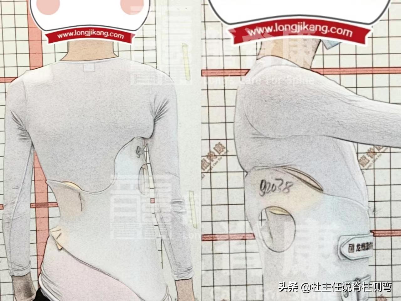 11至14岁青少年更易患脊柱侧弯,脊柱侧弯多少度会出现剃刀背