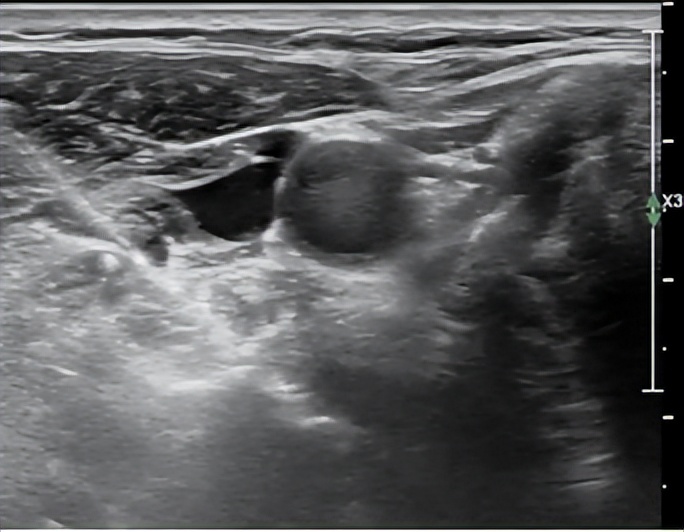 西安市红会医院北院区做微创手术,西安红会医院肌骨超声科
