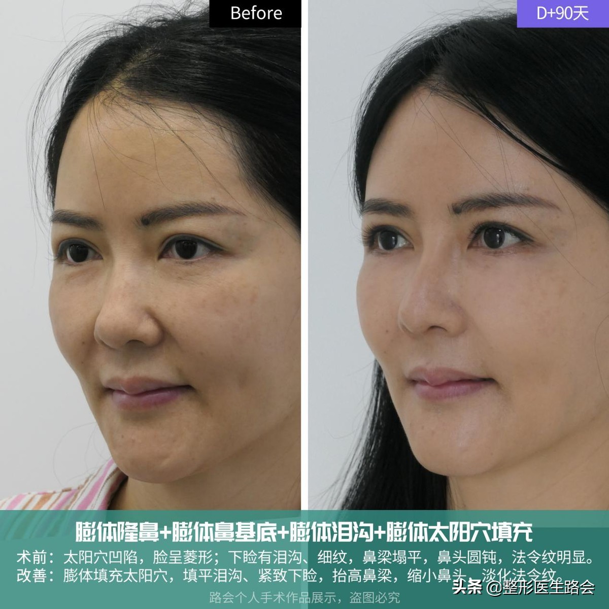 玻尿酸全脸填充年轻化,全脸玻尿酸填充真的会好看吗