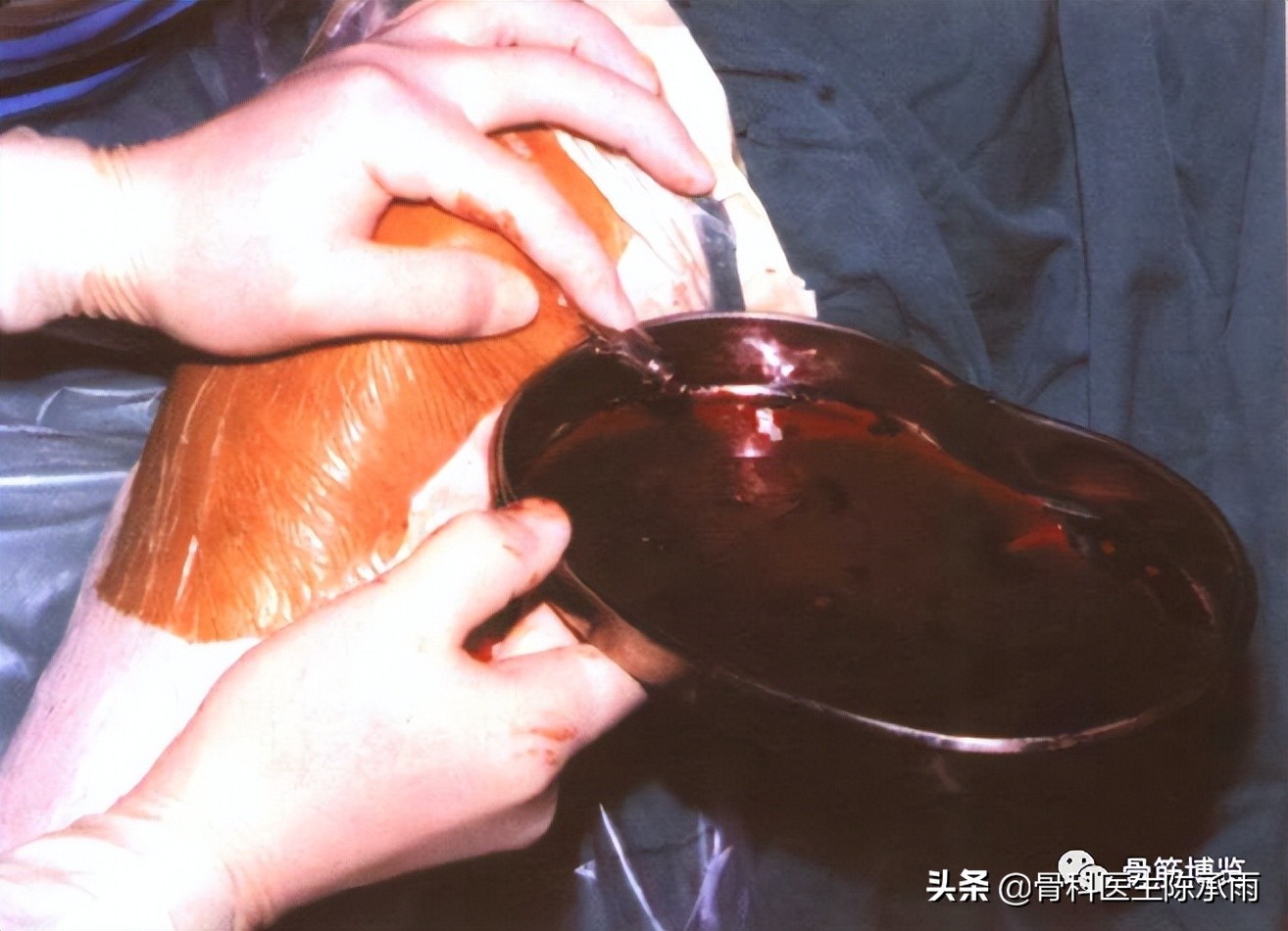 膝关节2度损伤需要做关节镜吗,膝关节常见损伤的检查方法