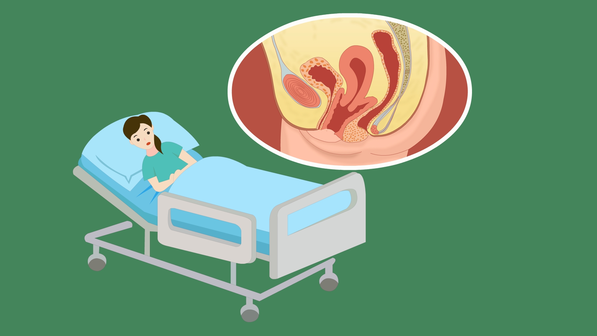 女性六十岁子宫脱垂怎么治疗,子宫脱垂一级的女性多吗