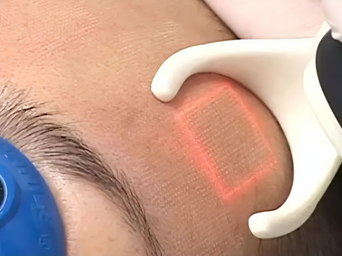 脸上到处是痘痘痘印痘坑怎么办,痘痘破了怎么处理不会留痘印痘坑