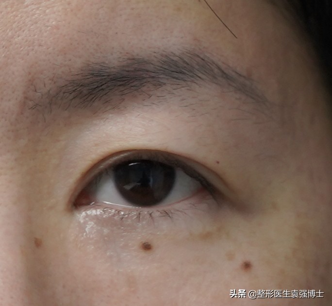 做完提眉后感觉很奇怪,做完提眉疼多久