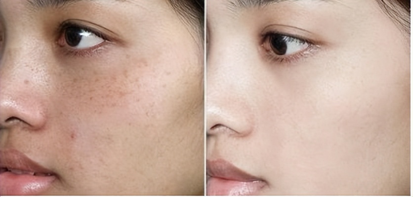 淡斑效果最好的大牌化妆品,祛斑美白淡斑护肤品